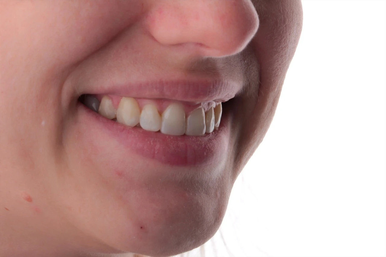 Doncaster Hill Dental First angled smile after Invisalign and composite veneer treatment