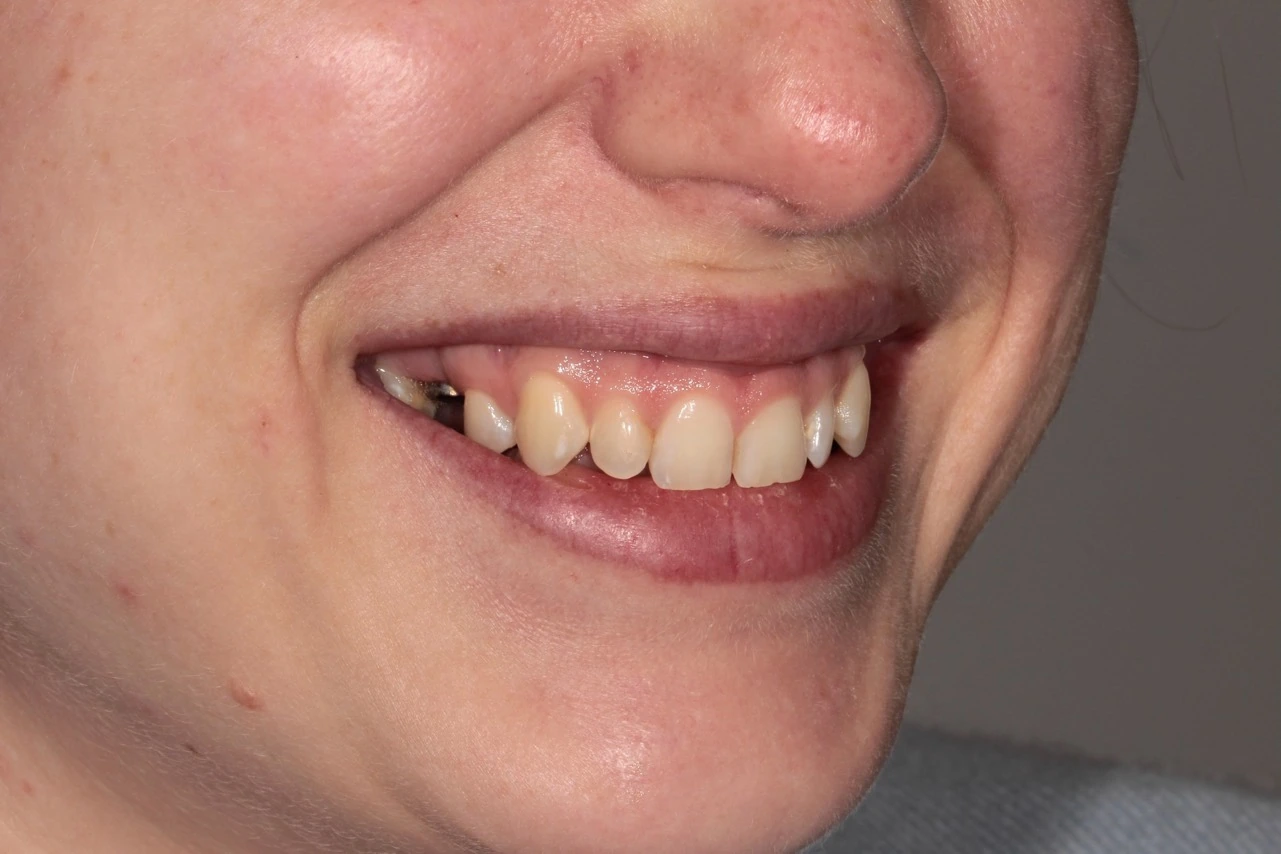 Doncaster Hill Dental First angled smile before combined orthodontic and veneer treatment