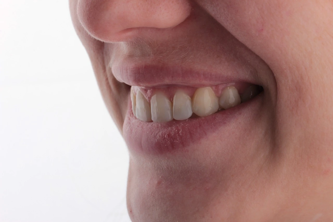 Doncaster Hill Dental Opposite angled smile after combined treatment