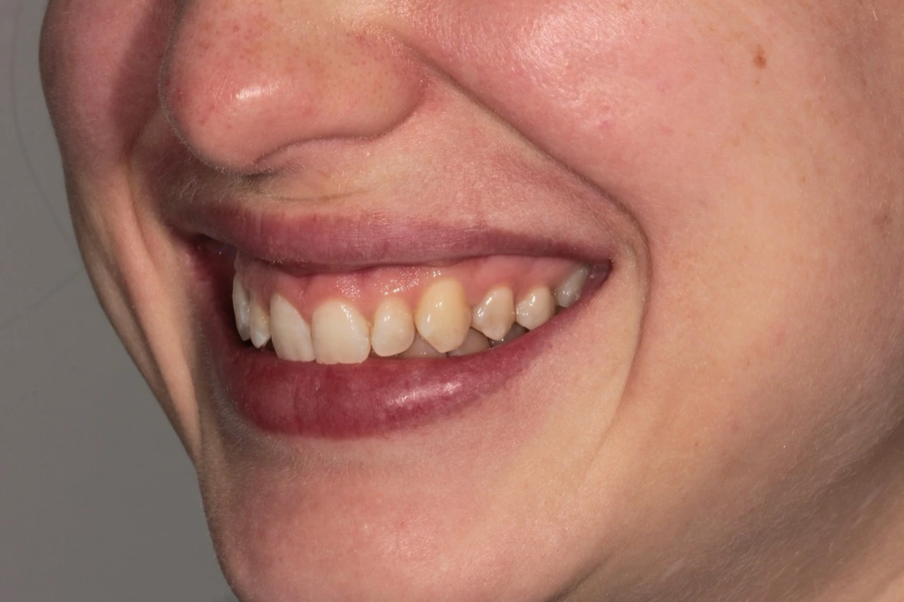 Doncaster Hill Dental Opposite angled smile before Invisalign and composite veneers