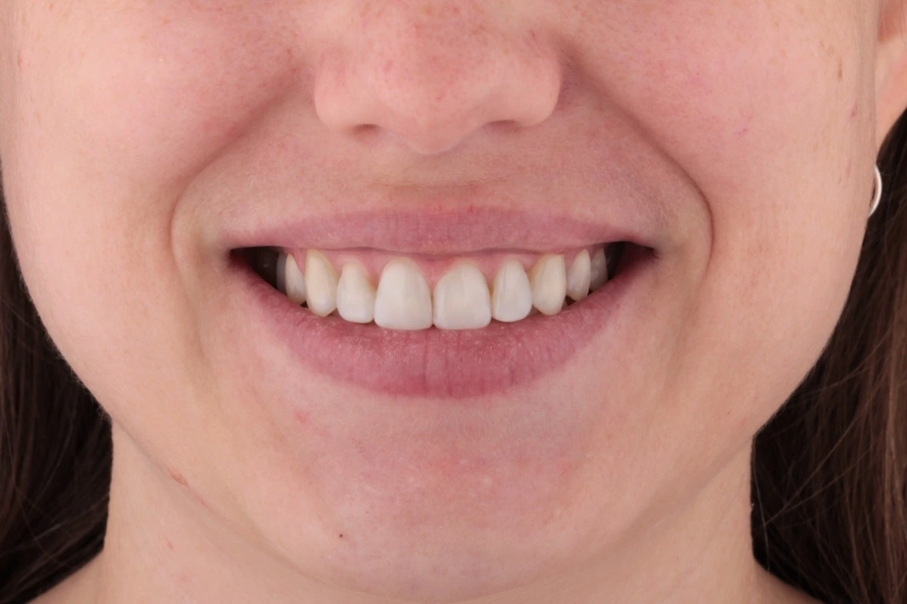Doncaster Hill Dental Front smile after Invisalign and six composite veneers