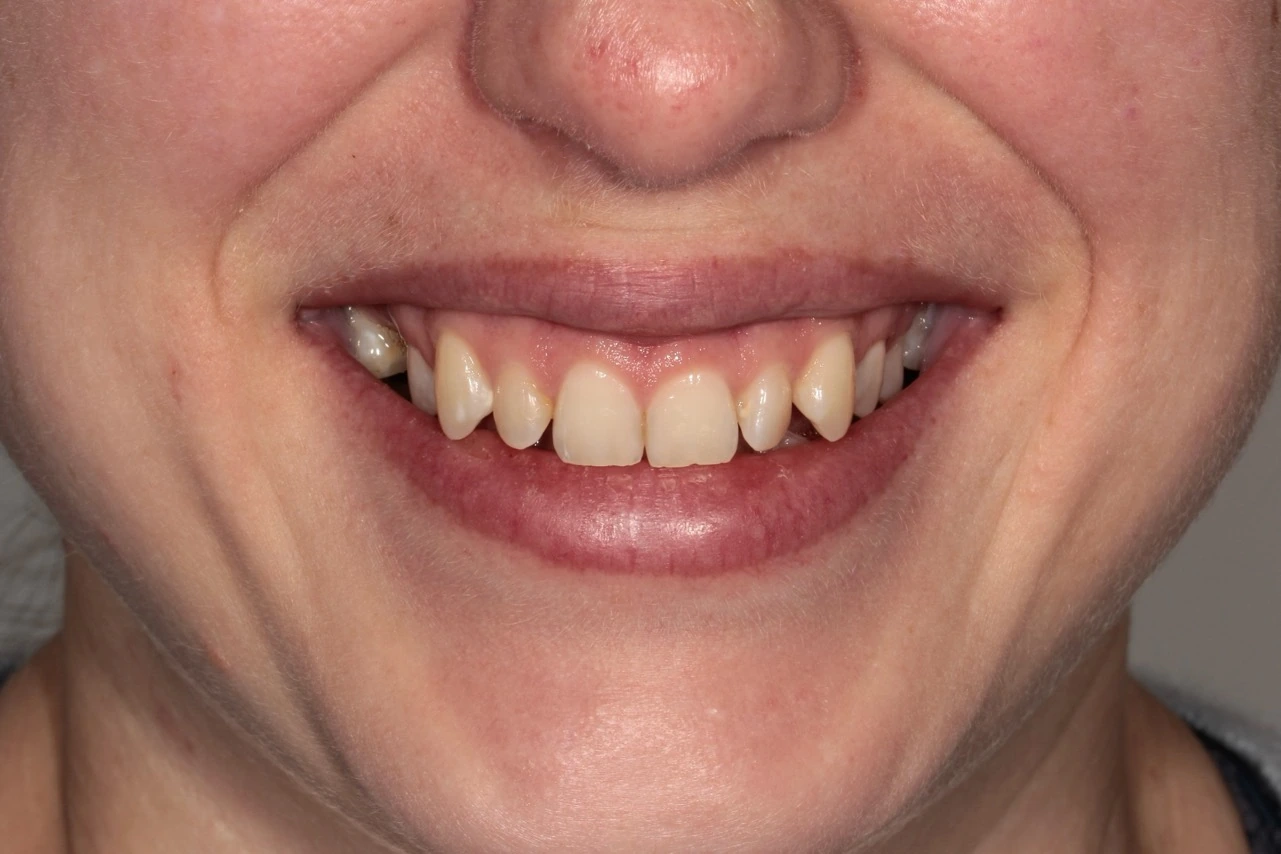 Doncaster Hill Dental Front smile before Invisalign and composite veneer treatment