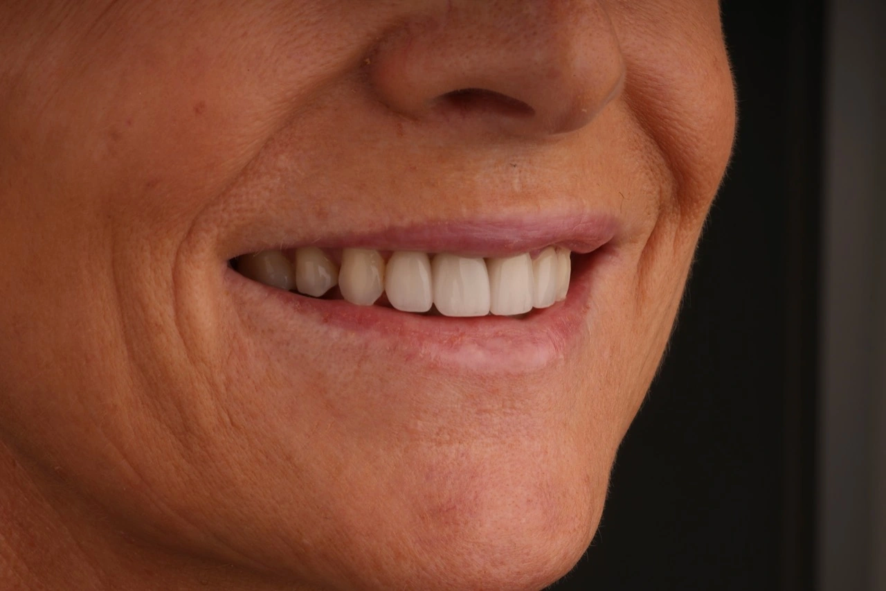 Doncaster Hill Dental First angled smile view after Invisalign and porcelain veneer treatment