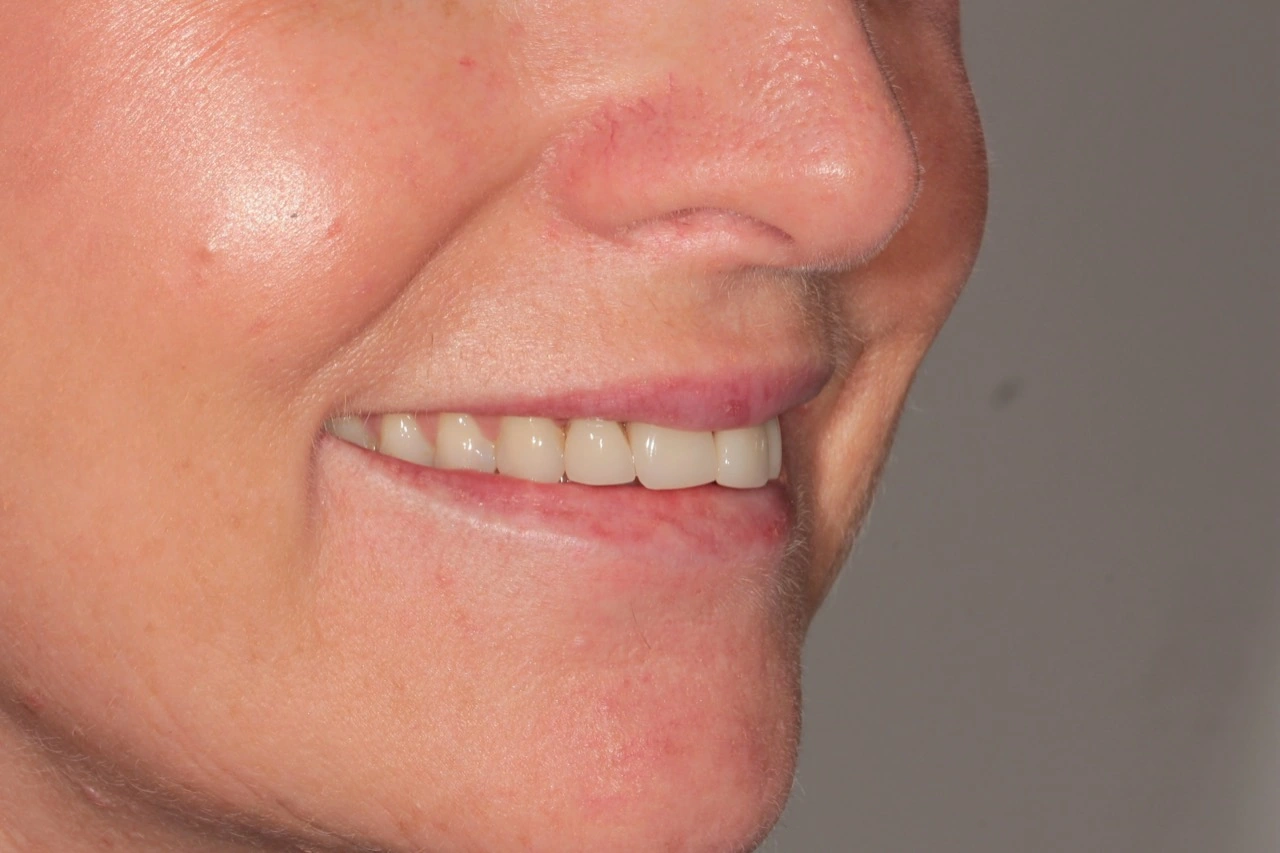 Doncaster Hill Dental First angled smile view before combined orthodontic and veneer treatment