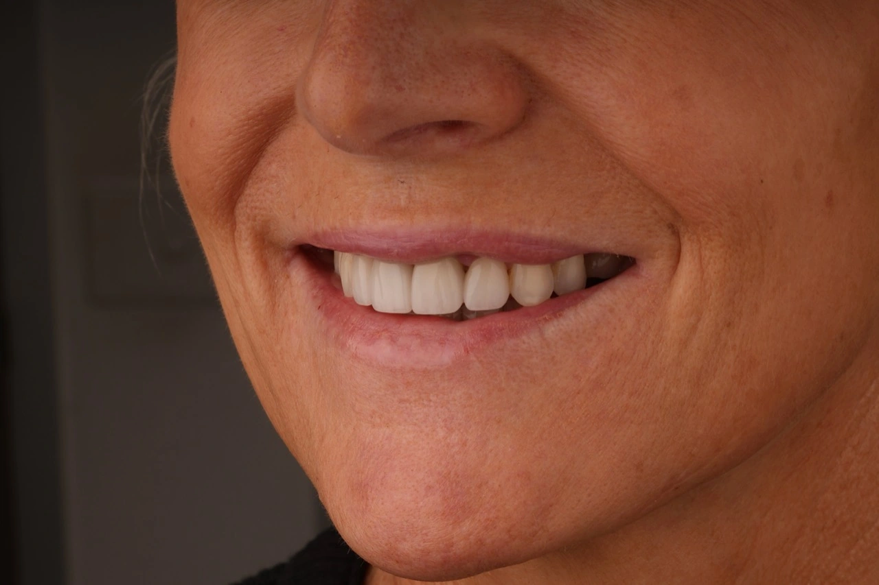 Doncaster Hill Dental Opposite angled smile view after combined treatment