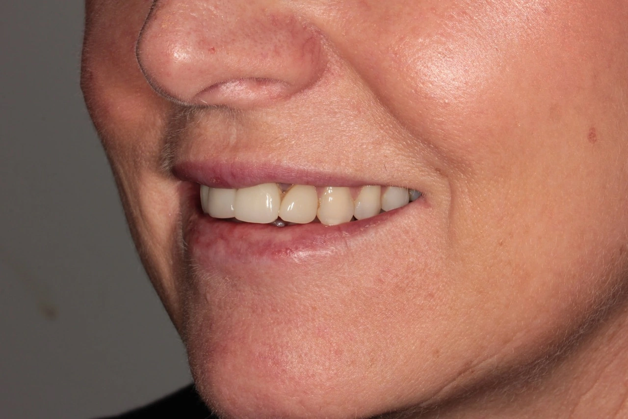 Doncaster Hill Dental Opposite angled smile view before Invisalign and porcelain veneer treatment