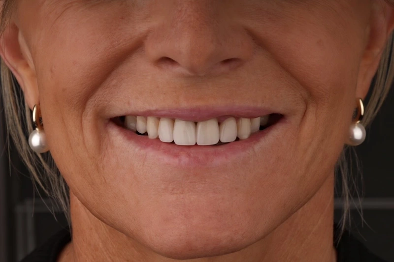 Doncaster Hill Dental Front smile after Invisalign and four upper porcelain veneers