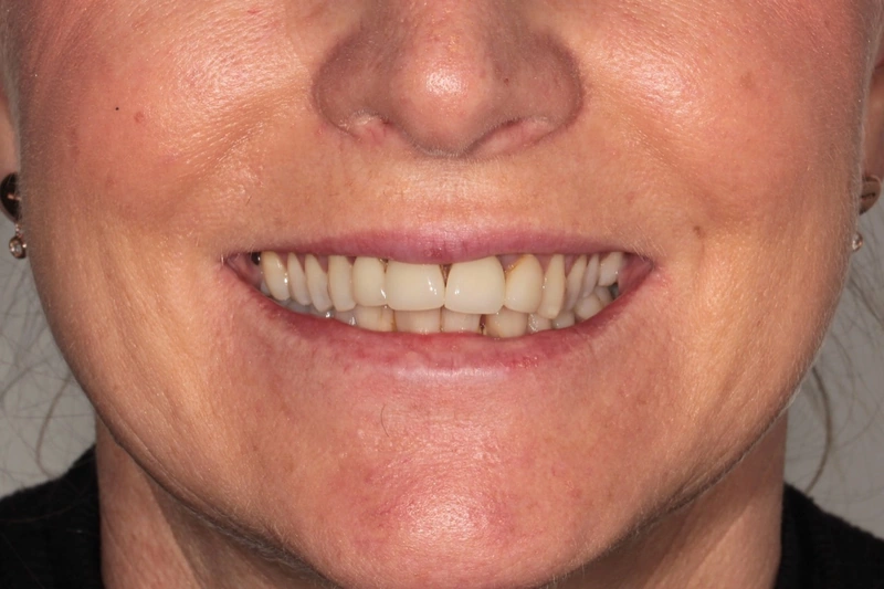 Doncaster Hill Dental Front smile before Invisalign and porcelain veneer treatment