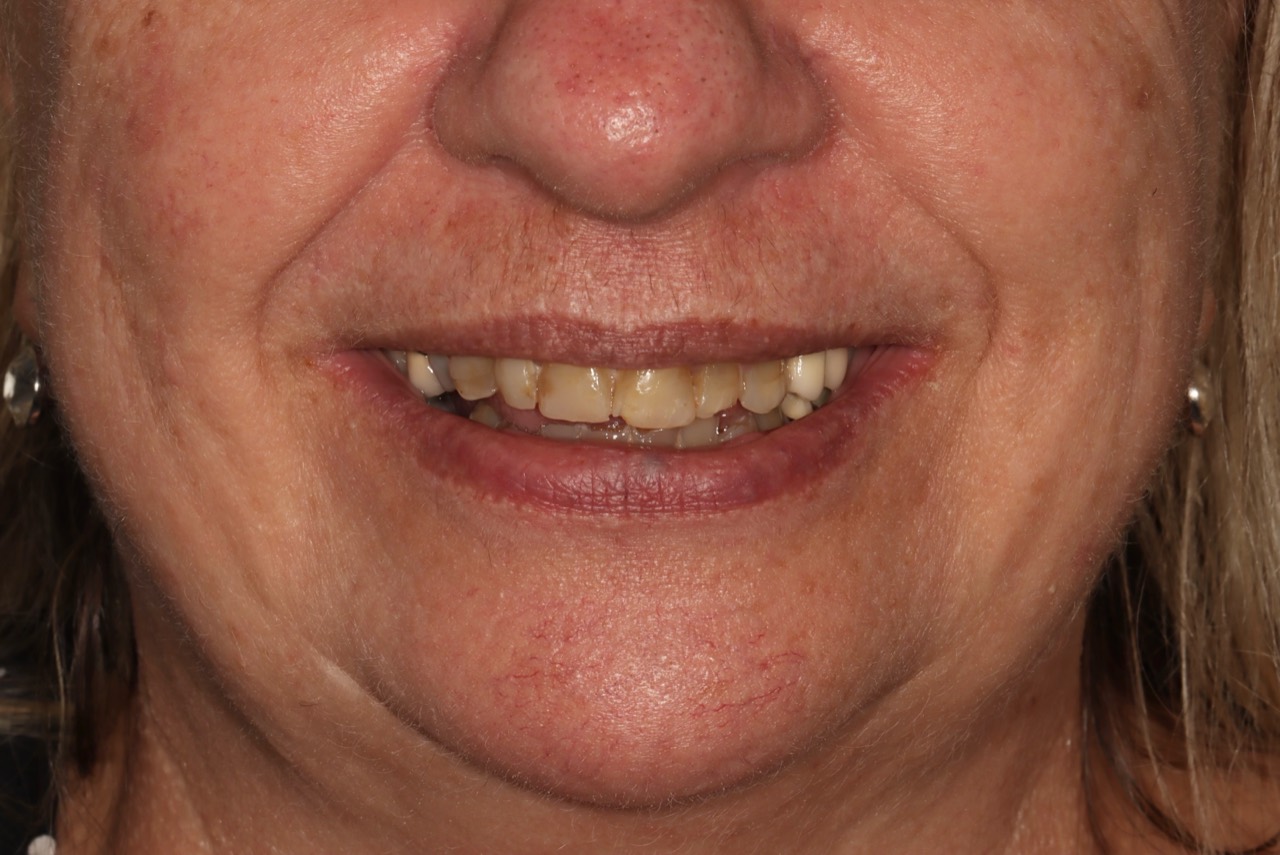 Doncaster Hill Dental Front smile before the staged worn-teeth rehabilitation