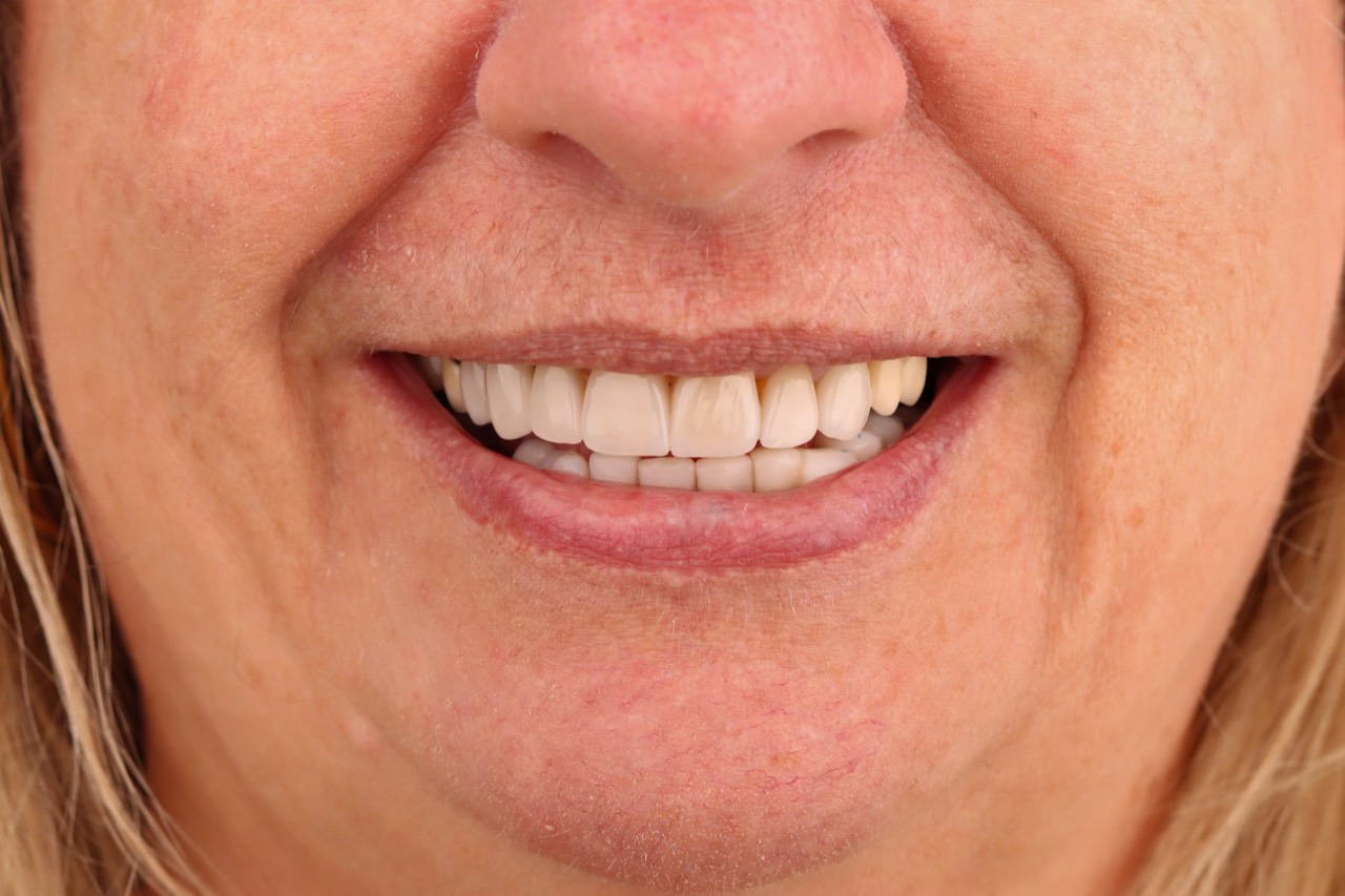 Doncaster Hill Dental Front smile after lower composite restorations and seven upper crowns, with implants still planned