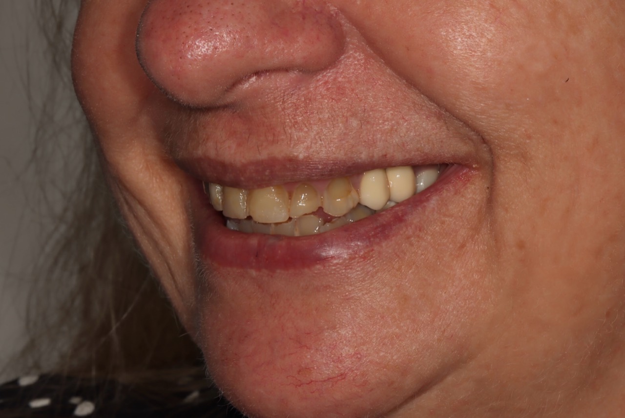 Doncaster Hill Dental First side view before the staged worn-teeth rehabilitation
