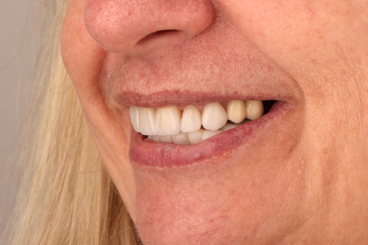 Doncaster Hill Dental First side view after lower composite restorations and seven upper crowns, with implants still planned