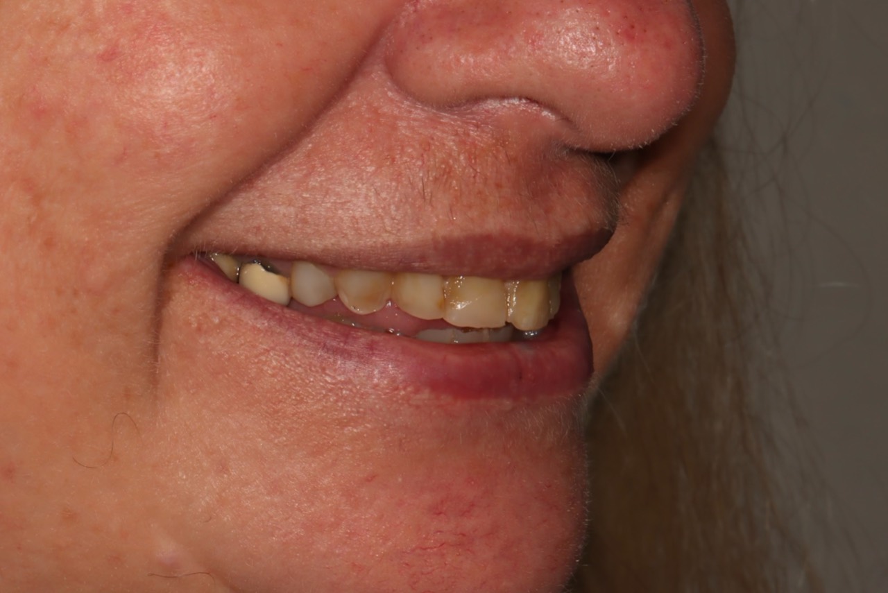 Doncaster Hill Dental Second side view before the staged worn-teeth rehabilitation