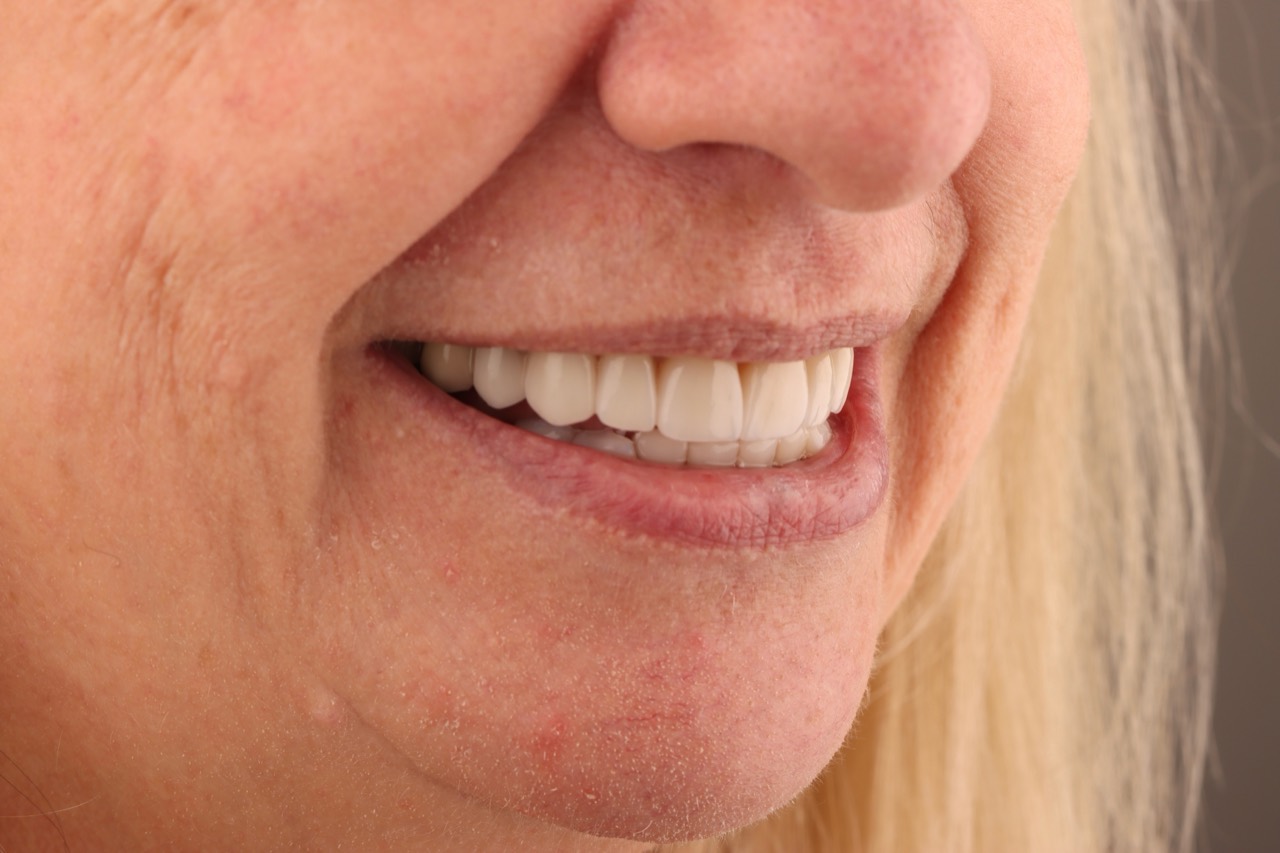 Doncaster Hill Dental Second side view after lower composite restorations and seven upper crowns, with implants still planned